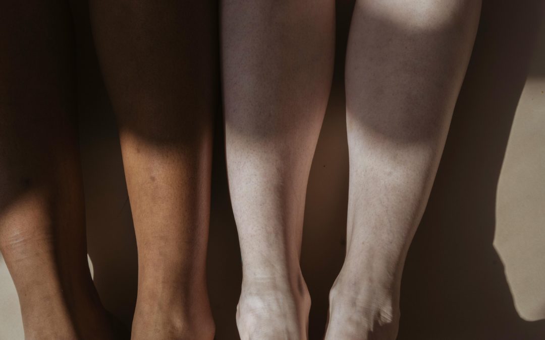 Dicke Beine durch Venenschwäche: Ursachen und Lösungen