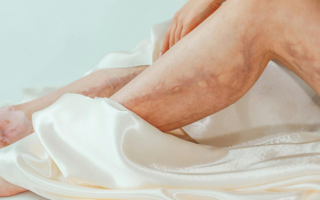 Krampfadern Innenseite Oberschenkel: Symptome & Therapie