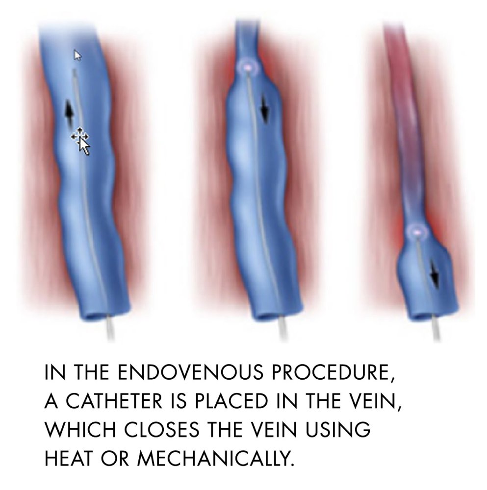 endovenous procedure veins