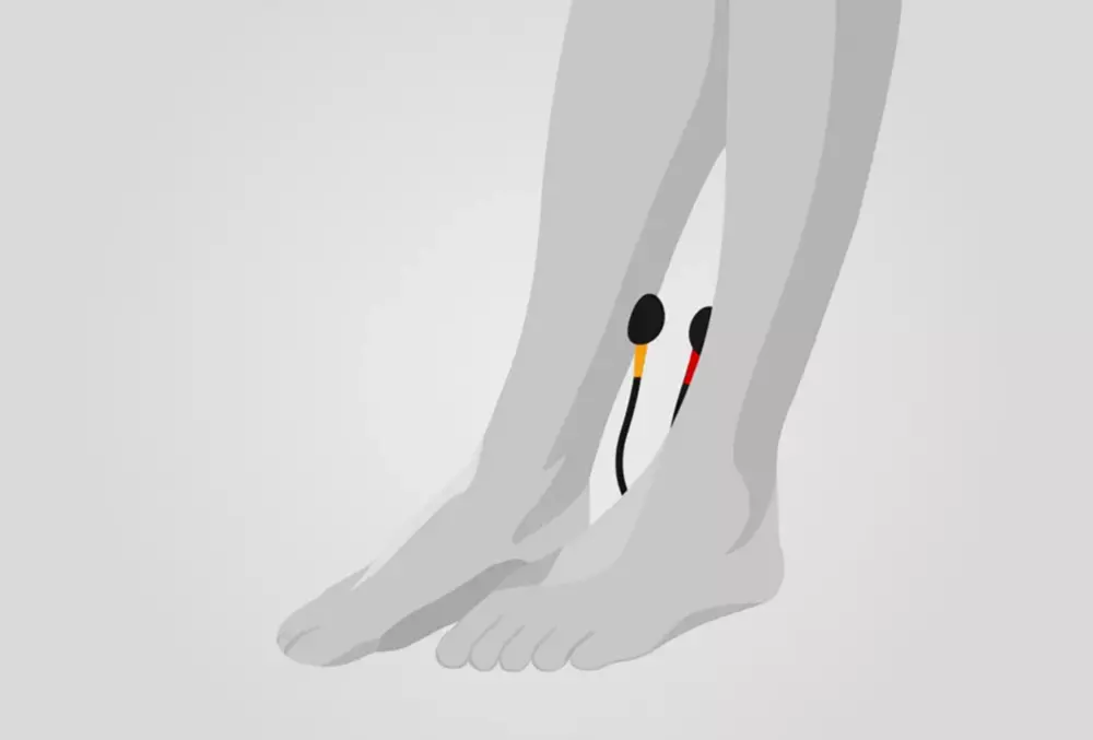 Diagnose Venen Infrarotmessung