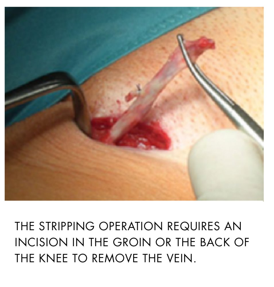 Stripping method veins