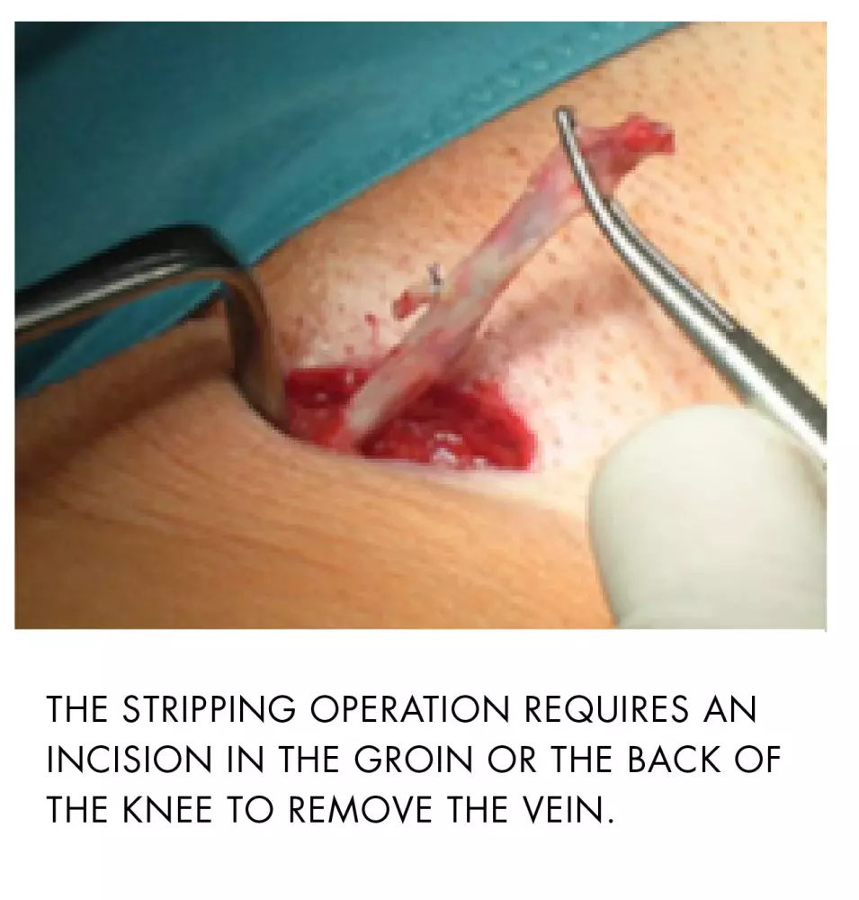 Stripping method veins