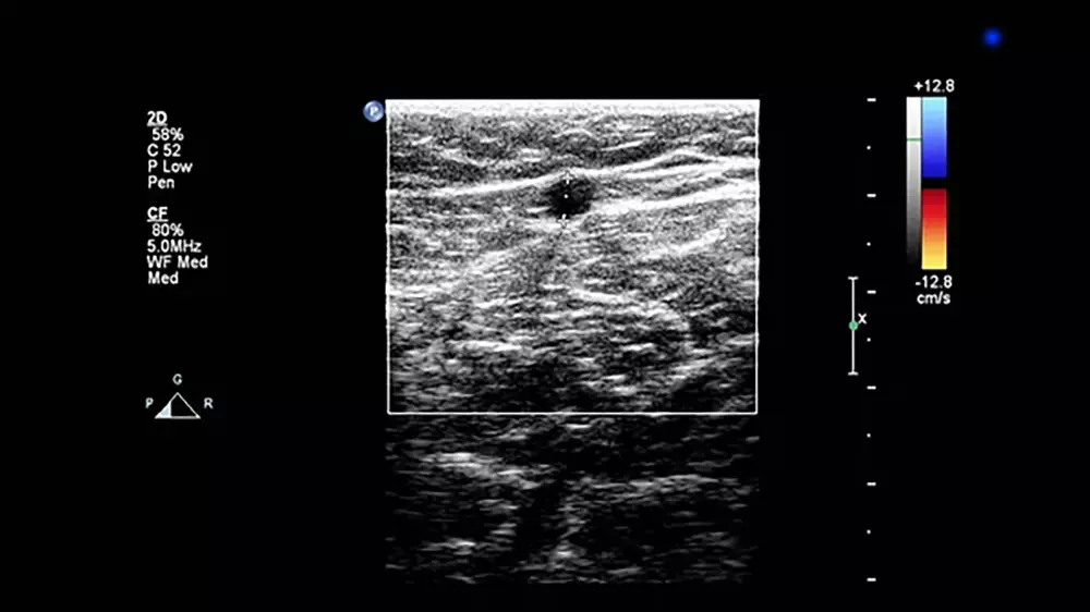 Diagnose Venen Ultraschalldoppler