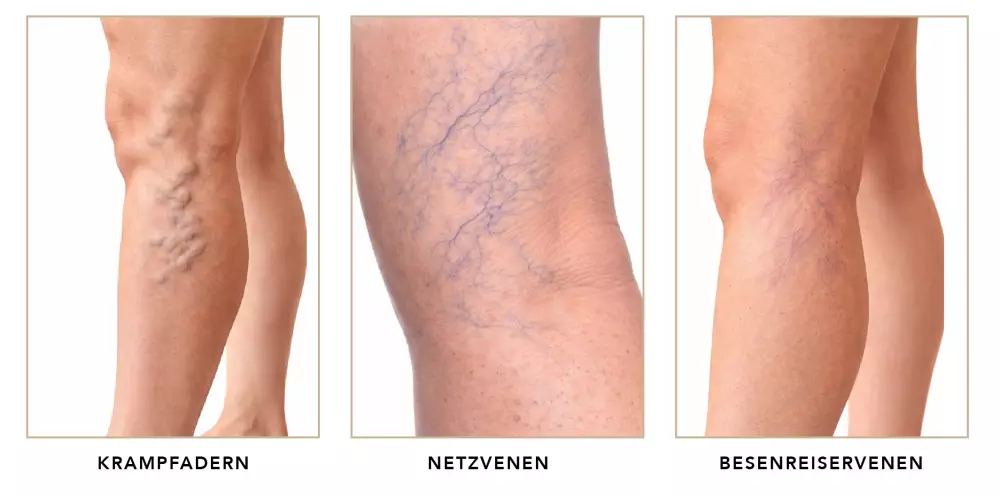 Typen von Krampfadern