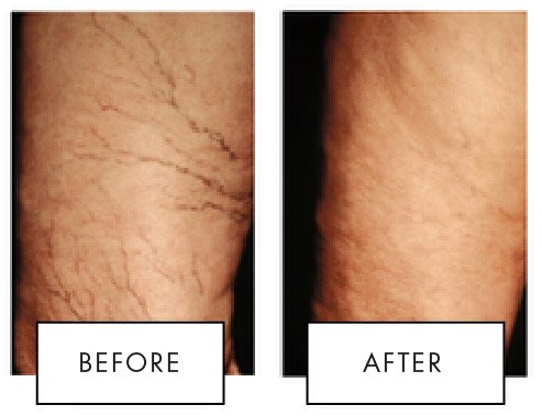 Spider Veins Sclerotherapy before after