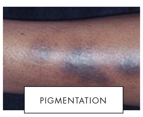 Skin pigmentation