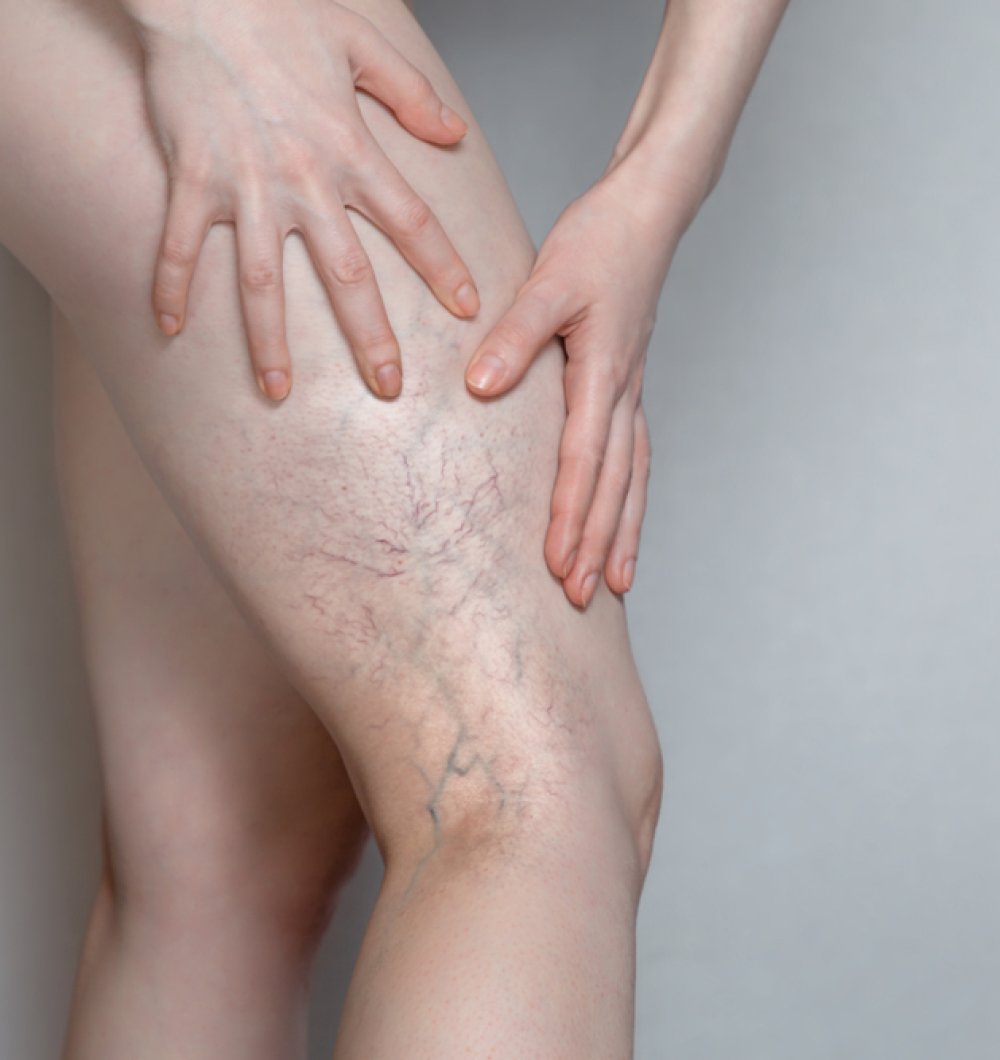 Besenreiser Behandlung