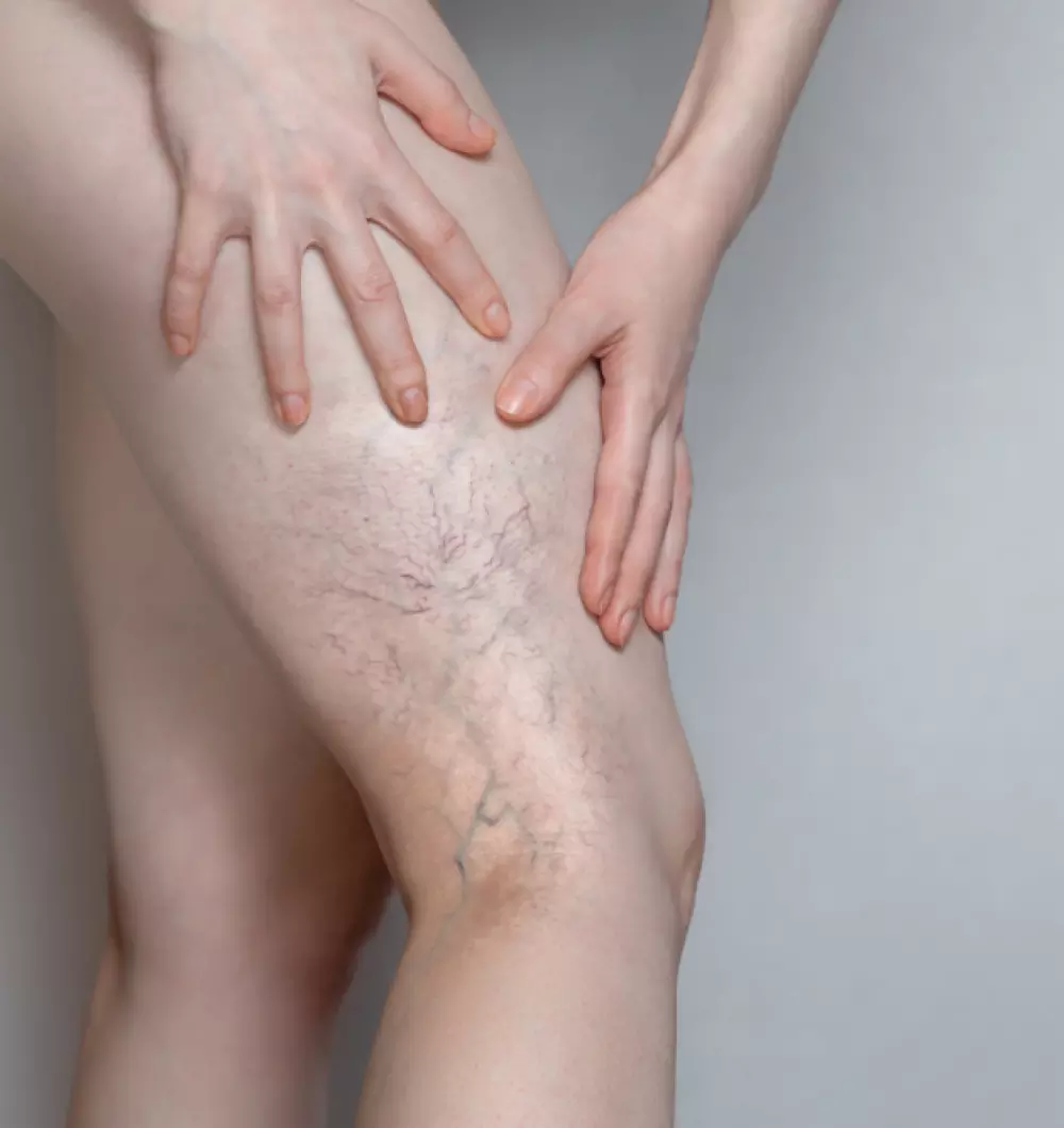 Spider vein treatment