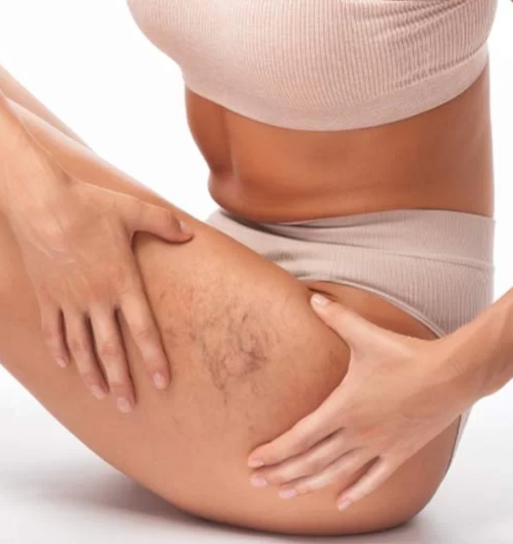 Spider veins