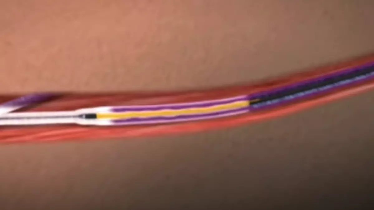 VNUS ClosureFast™ Sandhofer