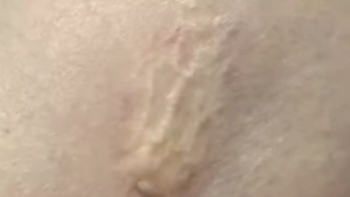 Besenreiser vorher / nachher