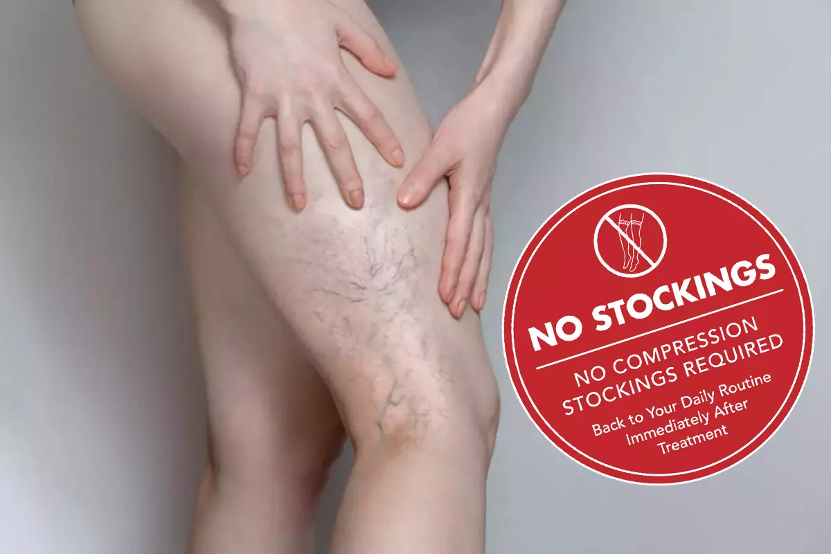 Spider vein treatment